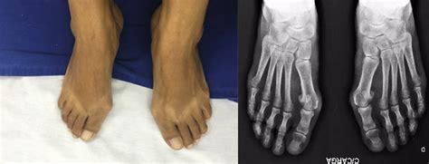 Cirurgia Percut Nea M Dicos Ortopedistas Em Curitiba Joao Luiz Vieira