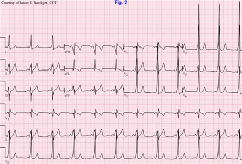 Delta wave | ECG Guru - Instructor Resources