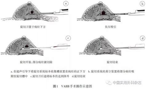 乳腺纤维腺瘤的临床表现及治疗 赵华栋副主任医师 爱问医生