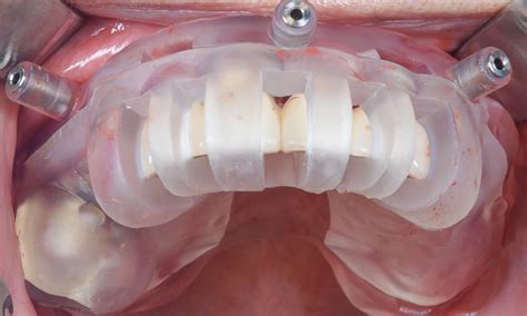 Digital workflow enhances edentulism treatment