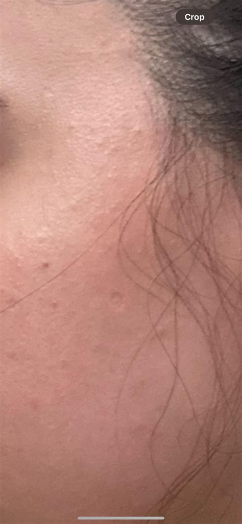 [acne] Fungal Acne Or Closed Comedones R Skincareaddiction