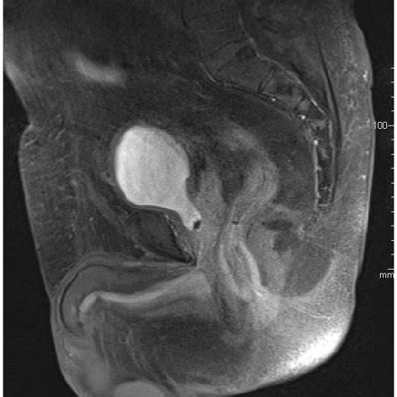 Sagittal View Of A Pelvic Magnetic Resonance Image One Month