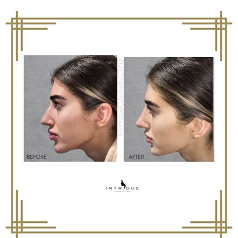 Rhinoplasty | Nose Job Fillers in Gravesend, Kent, Dartford and Bromley