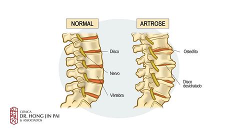 Hipertrofia Interapofisária Alterações Degenerativas nas Articulações