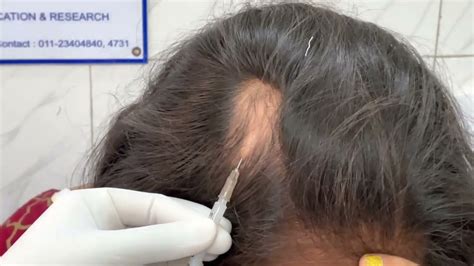 Alopecia Areata Treatment Injection