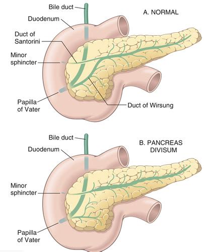 Pathology Of The Exocrine Pancreas Flashcards Quizlet