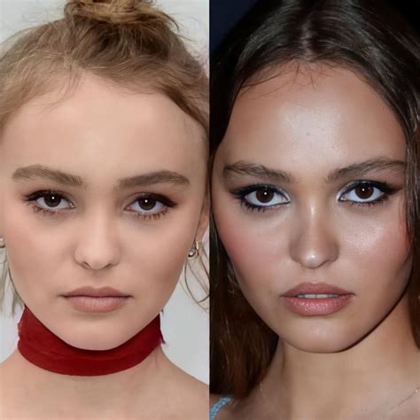 Did Lily Rose Depp Have Plastic Surgery