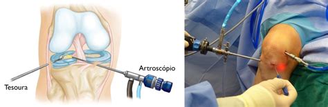 Rupturas Do Menisco Meniscus Tears OrthoInfo AAOS