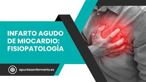 Infarto Agudo De Miocardio Fisiopatología Apuntes Enfermería