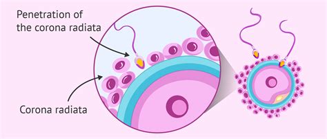 Penetration Of The Corona Radiata