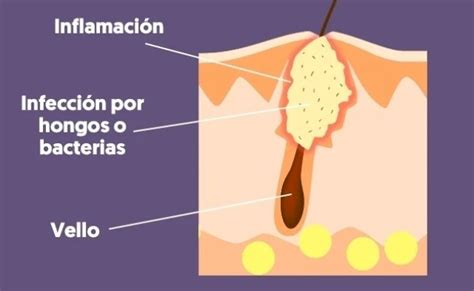 Foliculitis Que Es Causas Y Tratamiento Con Imagenes Tua Saude Otosection