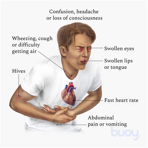 anaphylaxis - Plants Cures
