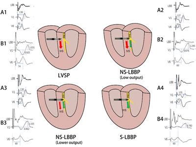 Frontiers Corrigendum Guidance On Left Bundle Branch Pacing Using