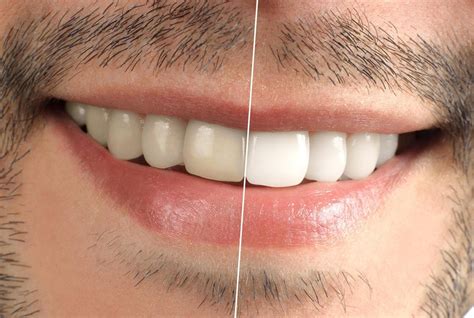 Lo que debes conocer antes de un blanqueamiento dental Estética dental