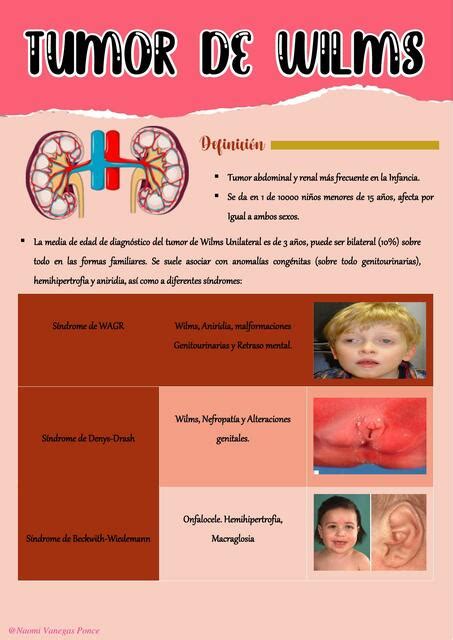 Tumor de Wilms El Rincón Médico uDocz