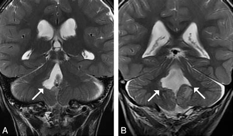 Cerebrocerebellar fissure | Semantic Scholar