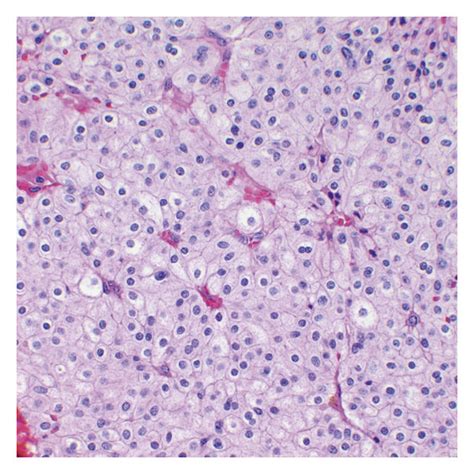 A Hematoxylin And Eosin Stain Demonstrating Representative