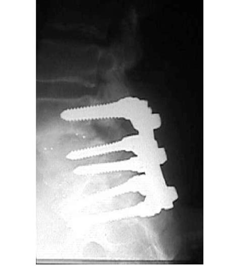 Posterior Lumbar Interbody Fusion This Shows L4 L5 And L5 S1 Download Scientific Diagram