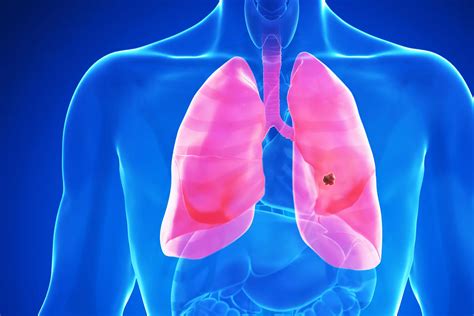 Lung Cancer Drug’s 'Off-the-Charts’ Results Give Patients Hope