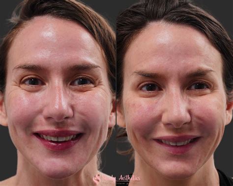 Botox Before And After Results Everything You Need To See Know