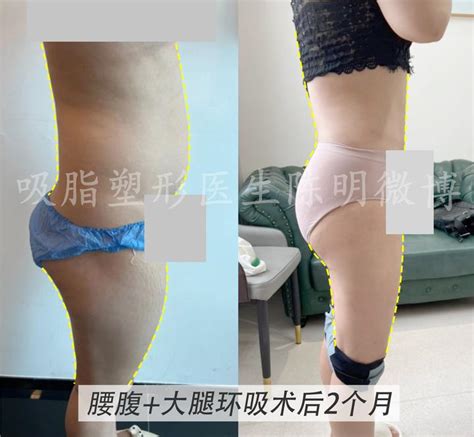 案例分享：腰腹大腿环吸术后2个月 知乎