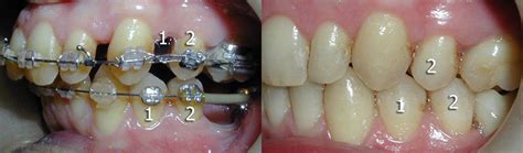 Before And After Pittsburgh Orthodontic Group