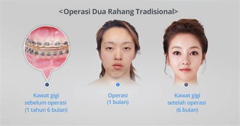 Operasi Rahang Terlebih Dahulu Di Korea Rahang 【id Hospital】