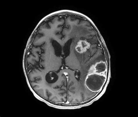 Fungal Cerebral Abscesses Image