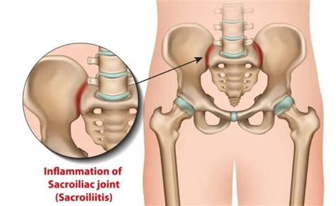 Best Treatment For Ankylosing Spondylitis In Guntur Dr Raos