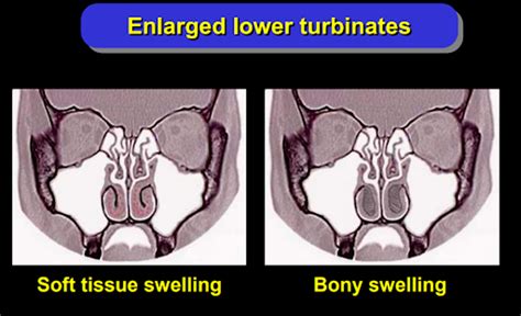 Turbinectomy Everything You Need To Know About The Surgery Ent