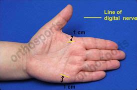 Administration Of Trigger Finger Injections Orthopaedic Surgeons