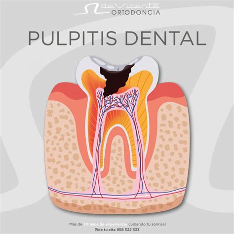 Sufres Pulpitis Dental Cl Nica Dental De Vicente Ortodoncia