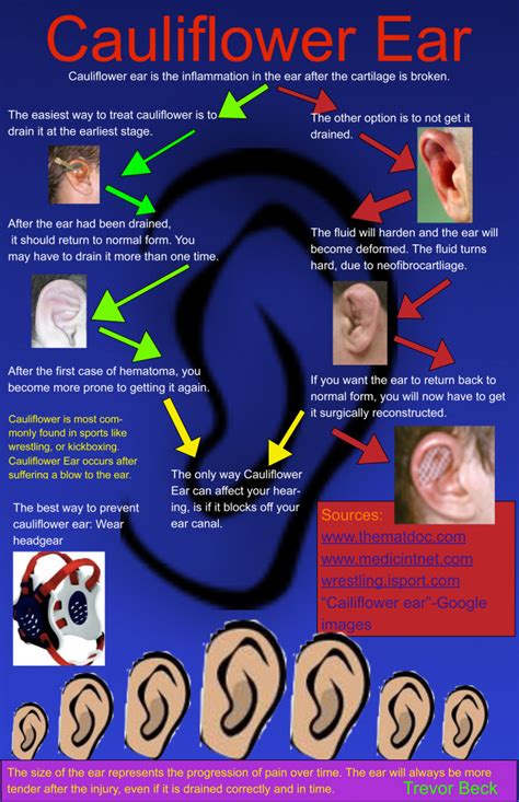 Infographic Cauliflower Ear Sli