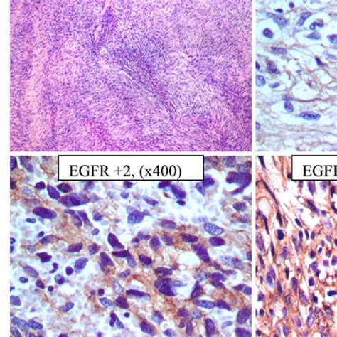 Immunohistochemical Staining For Egfr In Mpnst Download Scientific Diagram