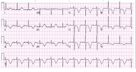 Atrial Vs Ventricular Paced Rhythm Top Sellers Jkuatacke