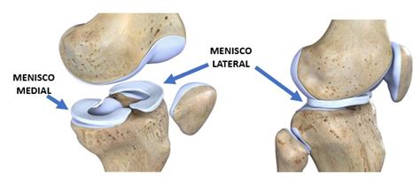 O que são os meniscos Cefor Fisioterapia Campinas