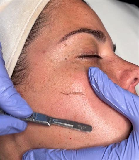 What Is Dermaplaning Sugared South Lake Tahoe