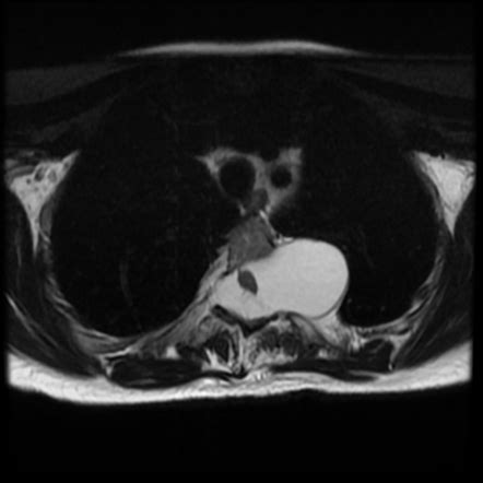 Lateral Thoracic Meningocele Radiology Case Radiopaedia Org