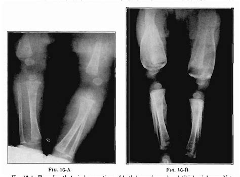 Figure 1 from Injuries Involving the Epiphyseal Plate | Semantic Scholar