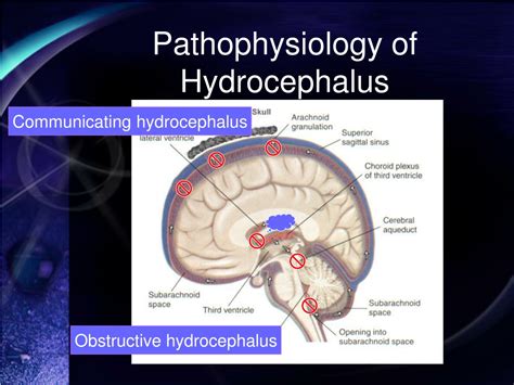 Ppt Normal Pressure Hydrocephalus Nph Powerpoint Presentation Free Download Id9398325