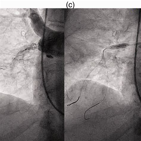 Balloon Pulmonary Angioplasty Of Right Pulmonary Artery Pouch