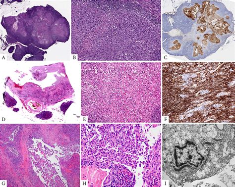 EWSR1 FUSCREB Fusions Define A Distinctive Malignant Epithelioid