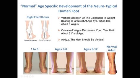 Treating Common Foot Conditions in Teens to Adults with Down Syndrome ...