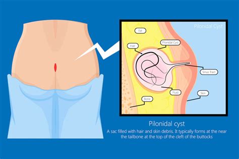 What You Need To Know About Pilonidal Cysts Sergio Mazzei