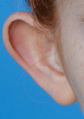 Otoplasty Best Surgeon Ear Surgery Nyc Prominent Ears