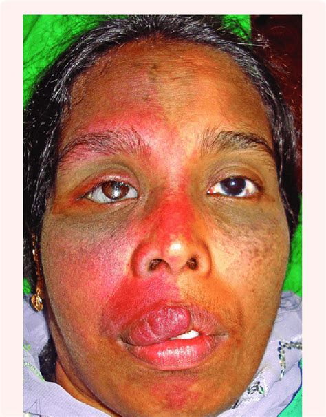 A: Diffuse reddish-pink macule of the right face with prominent right ...