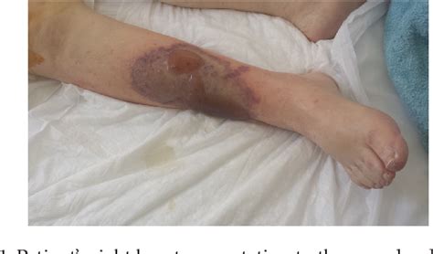 Figure 1 From Dabigatran In The Treatment Of Warfarin Induced Skin Necrosis A New Hope