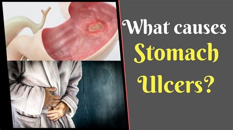 Stomach Ulcer Causes