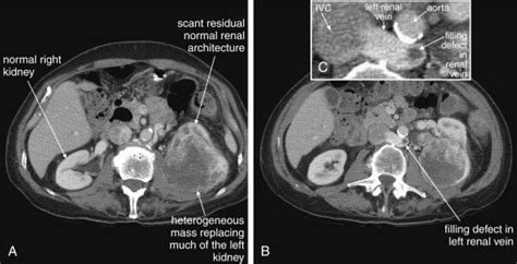 Imaging The Genitourinary Tract Radiology Key