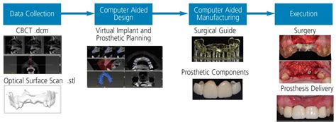 The Impact Of Digital Workflows On Implant Treatment Decisions In